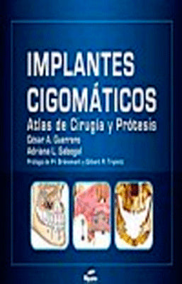 IMPLANTES CIGOMATICOS