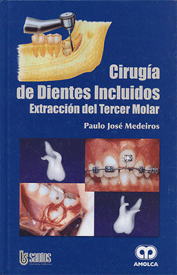 CIRUGIA DE DIENTES INCLUIDOS EXTRACCION DEL TERCER MOLAR