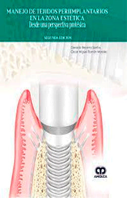 MANEJO DE TEJIDOS PERIIMPLANTARIOS EN LA ZONA ESTETICA DESDE UNA PERSPECTIVA PROTESICA