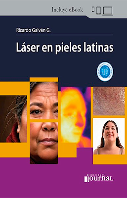 LASER EN PIELES LATINAS
