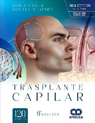 TRANSPLANTE CAPILAR 6ED