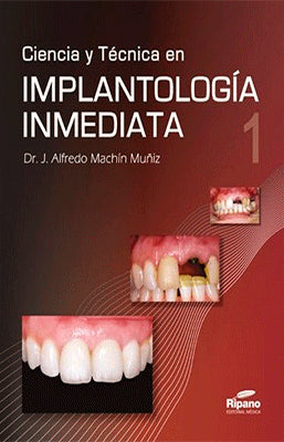 CIENCIA Y TECNICA EN IMPLANTOLOGIA INMEDIATA