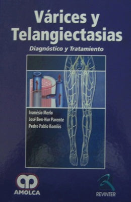 VARICES Y TELANGIECTASIS DIAGNOSTICO Y TRATAMIENTO