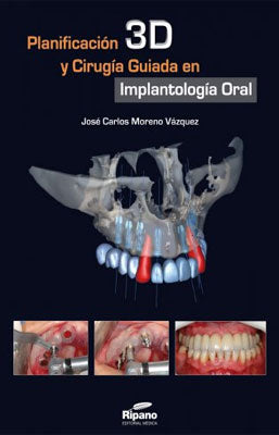 PLANIFICACION 3D Y CIRUGIA GUIADA EN IMPLANTOLOGIA ORAL