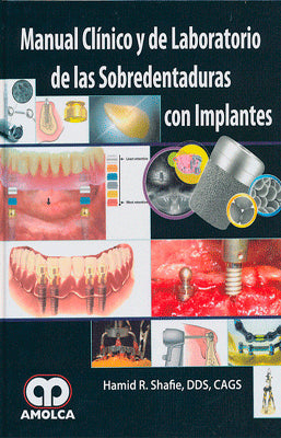 MANUAL CLINICO Y DE LABORATORIO DE LAS SOBREDENTADURAS CON IMPLANTES