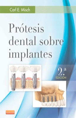 PROTESIS DENTAL SOBRE IMPLANTES